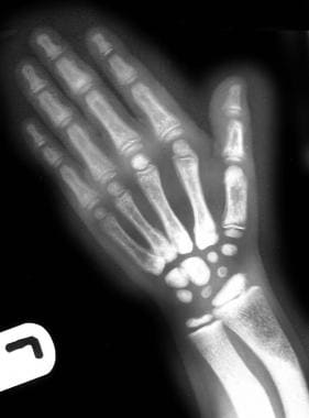 Radiograph of the left hand of a 6-year-old girl w