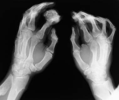 Radiographs of both hands of 36-year-old man show 