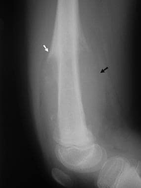 Lateral radiograph of the distal femur in a child 