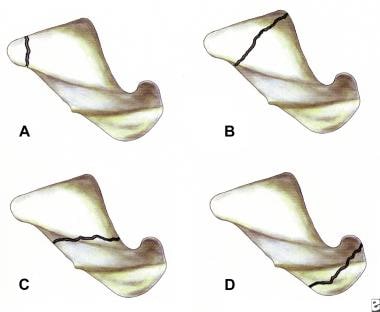 Pictures show the locations of fracture within the