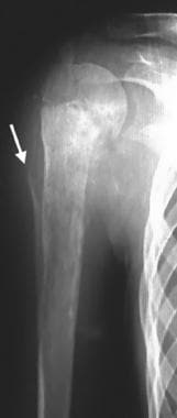 Frontal radiograph in a 16-year-old girl with pain