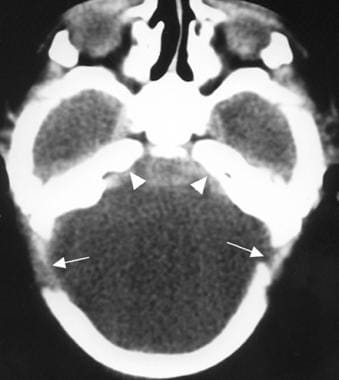 An axial CT scan in a 1-day-old boy that shows a l