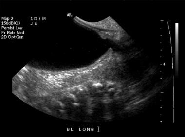 Longitudinal sonogram of the bladder. This image d