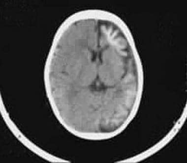 Axial nonenhanced CT scan shows left hemiatrophy o