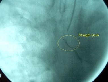 Bronchial artery embolization in a 46-year-old man