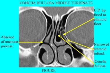 CT扫描，鼻腔。左边的Concha Bullosa