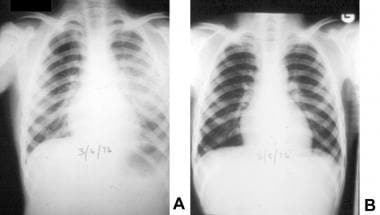 Posteroanterior chest radiographs reveal the natur