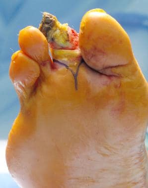 Markup for second-toe amputation: posterior view. 