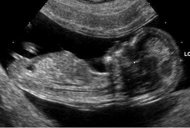 A) A B-mode ultrasound image of a bladder in a transverse section