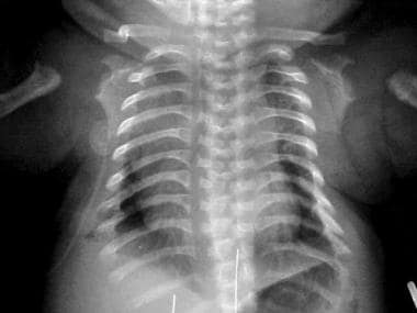 A chest radiograph of a newborn with achondroplasi