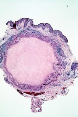Histopathology of lupus miliaris disseminatus faci