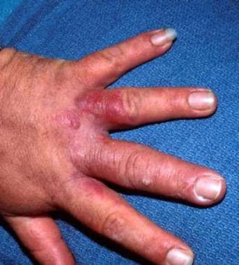Erysipeloid. Courtesy of the Department of Dermato