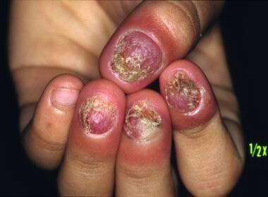 Candidal onychomycosis in a patient with chronic m