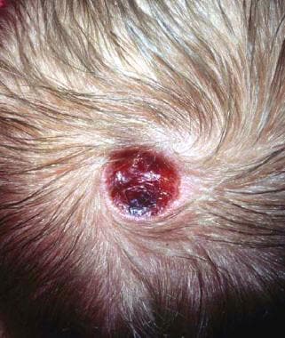 Aplasia cutis congenita on the scalp (most common 