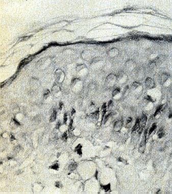 Higher-power photograph shows slight vacuolar basi