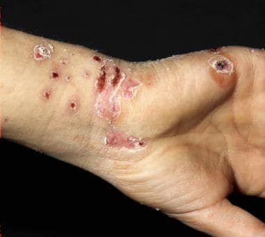 A 16-year-old boy with generalized cowpox. Courtes