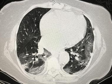 Axial chest CT demonstrates patchy ground-glass op