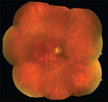 Fundus photograph of BCR. The lesions are at the l
