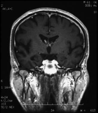 Coronal T1-weighted magnetic resonance imaging (MR