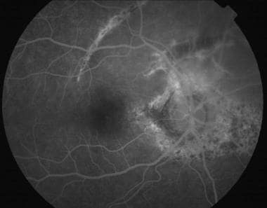 Late-phase fluorescein angiogram in a 23-year-old 