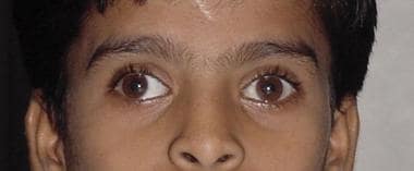 Patient with intermittent exotropia at distance on