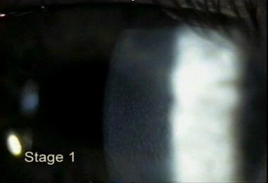 Diffuse lamellar keratitis - Stage 1. 