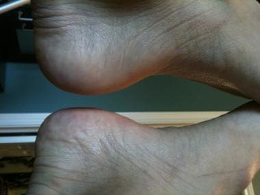 Edema localized to plantar heel on the left foot i