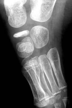 Radiograph from patient with Köhler disease. Image