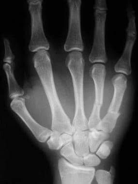 metacarpal x ray