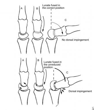 Wrist arthrodesis. Schematic emphasizing need for 