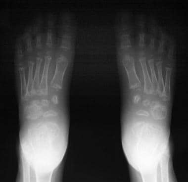 Anteroposterior (AP) radiographs of the feet. 