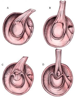 Superior labrum anterior and posterior (SLAP) lesi