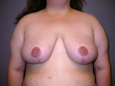 Postoperative photograph of the breasts of patient