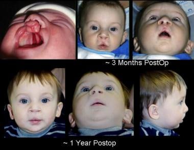 Preoperative and postoperative images of a child b