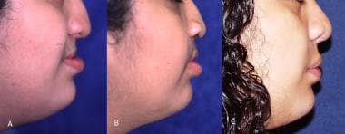A. Female (age 13 years) with midface deficiency s