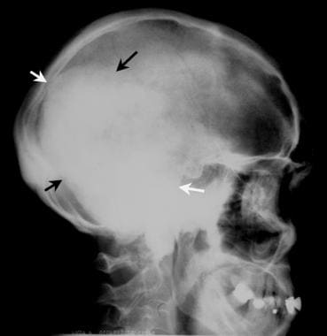Plain lateral skull radiograph in a patient with k