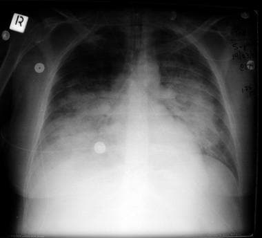 Acute respiratory distress syndrome (ARDS) present