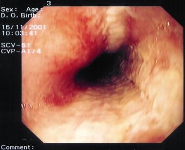 Corrosive esophagitis. This is a vinegar-induced e