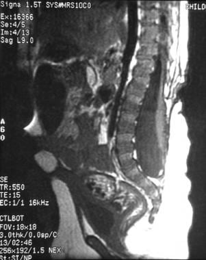 Sagittal T1-weighted MRI image of a child after cl