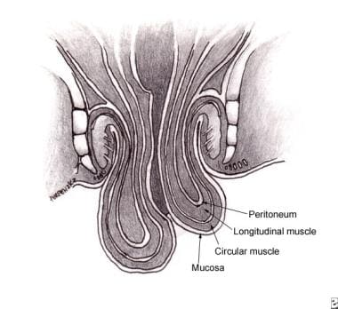 Rectal Prolapse: Practice Essentials, Anatomy, Pathophysiology