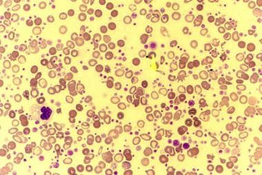 Peripheral smear of a patient with essential throm