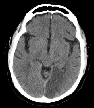 posterior cerebral artery distribution