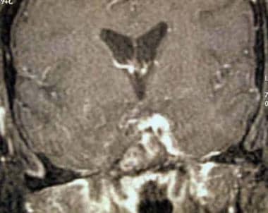 CT brain scan illustrating the appearance of caver