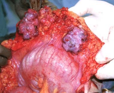 Metastases from epithelial ovarian carcinoma invol