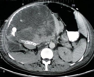 A 68-year-old woman with a large right upper quadr
