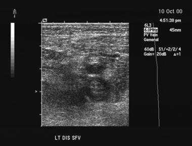 This ultrasonogram shows a thrombus in the distal 