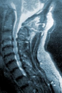 T2加权颈椎磁共振成像
