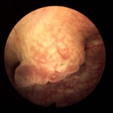Bladder cancer. Sessile lesions as shown usually i