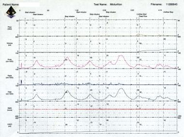 Urinary Incontinence: Practice Essentials, Background, Anatomy