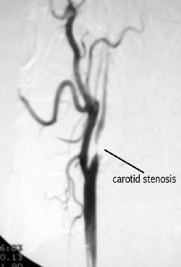 Arteriogram of carotid stenosis. 